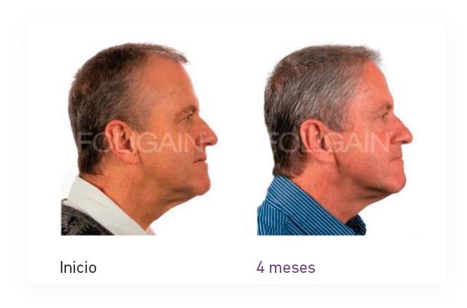 Tratamiendo para el crecimiento del cabello hombre - foligain