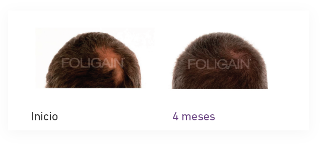 Tratamiento para el crecimiento del cabello hombre - Foligain