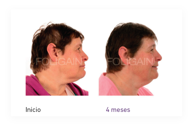 Tratamiento crecimiento del cabello mujer - Foligain