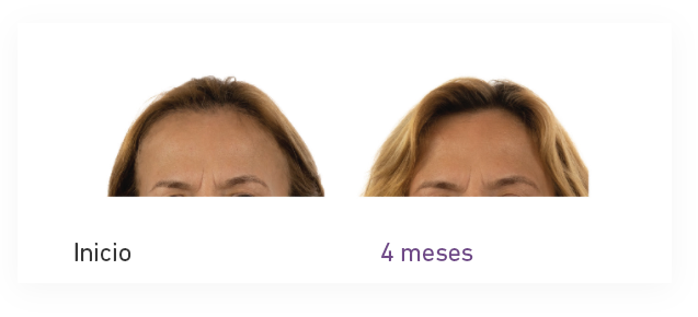 Tratamiento para el creciento del cabello mujer - Foligain